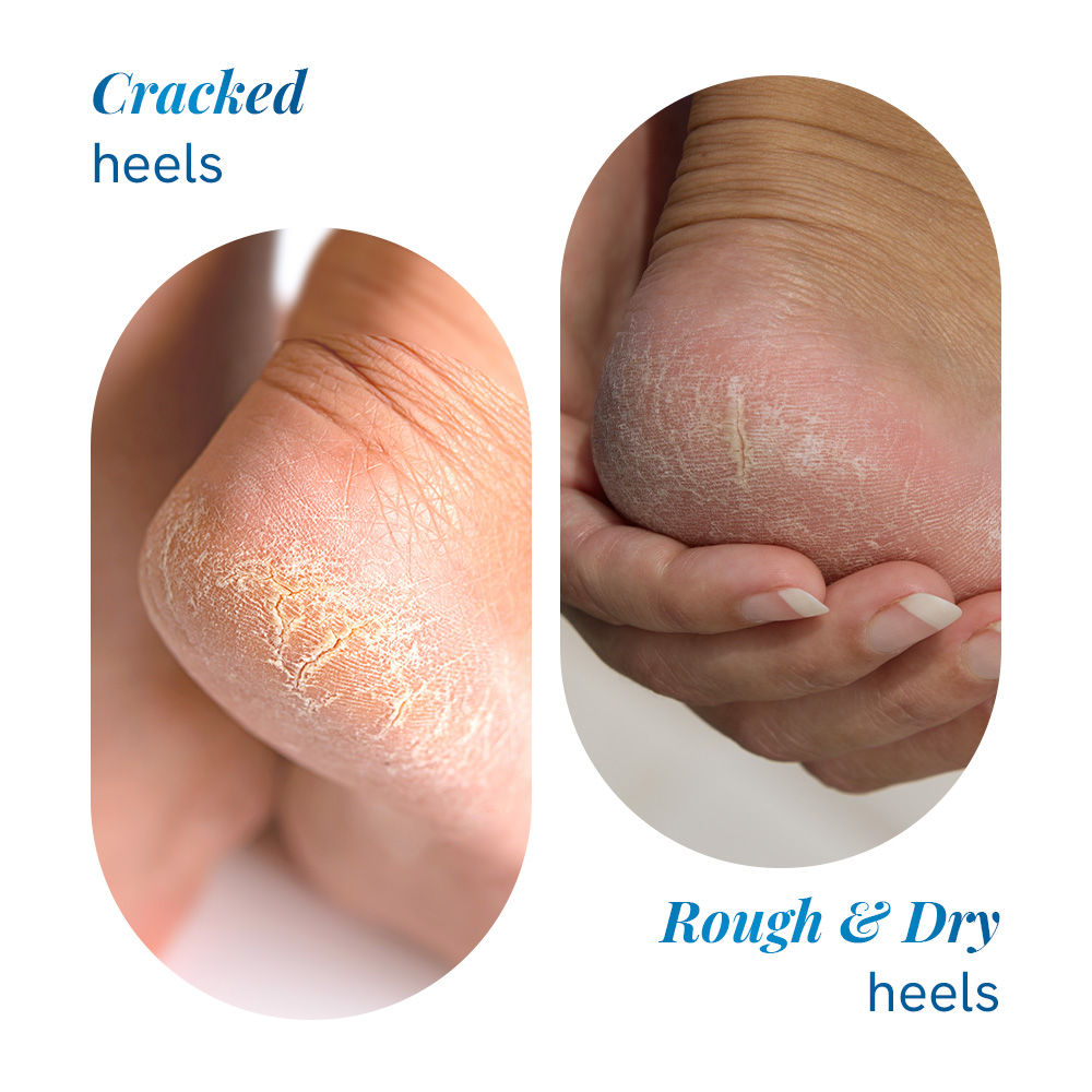 20% Urea Foot & Heel Roll On For Dry Feet & Cracked Heels With Urea & Lactic Acid