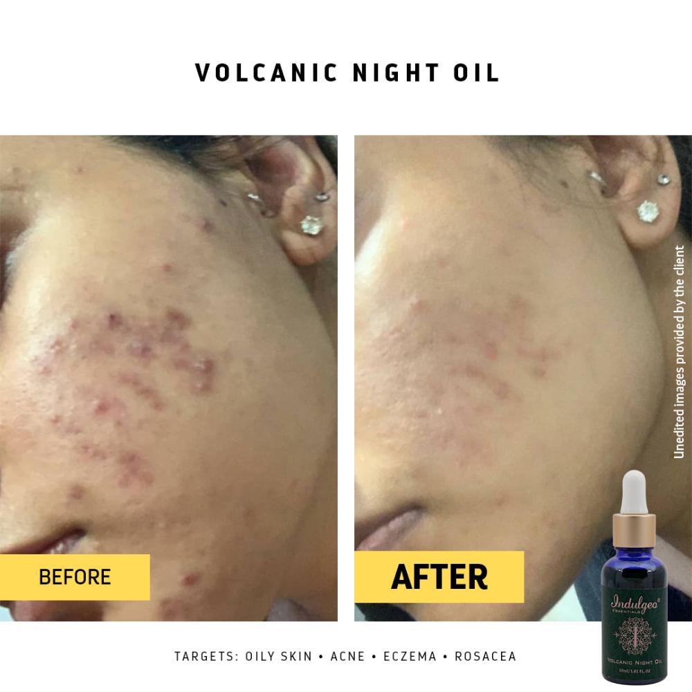 Volcanic Night Oil For Oily Acne Prone Skin With Tamanu Oil