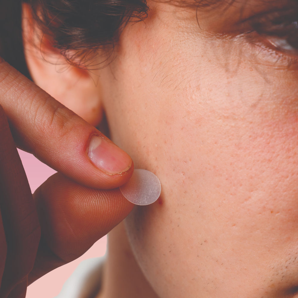 Pimple Patch With Hydrocolloid & Salicylic Acid For Acne Healing & Spot Correction