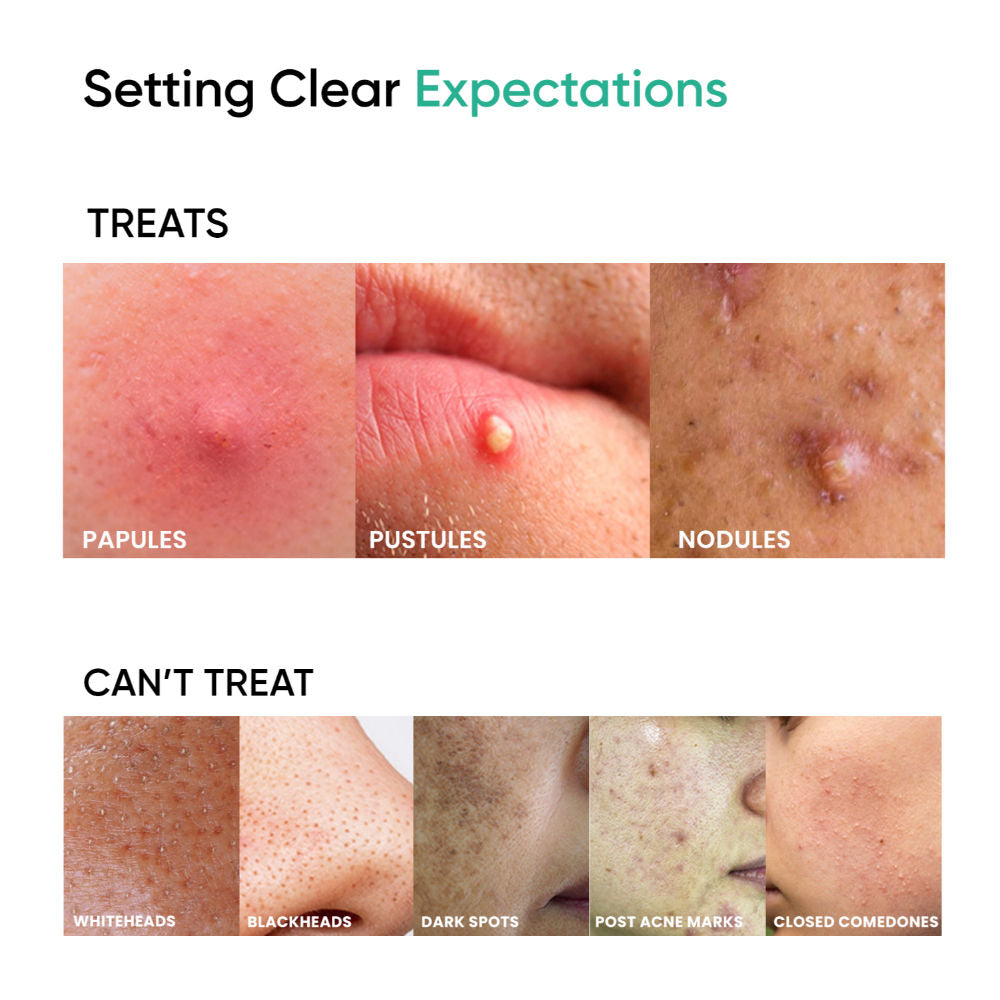 Acnil3 Rapid Spot Corrector