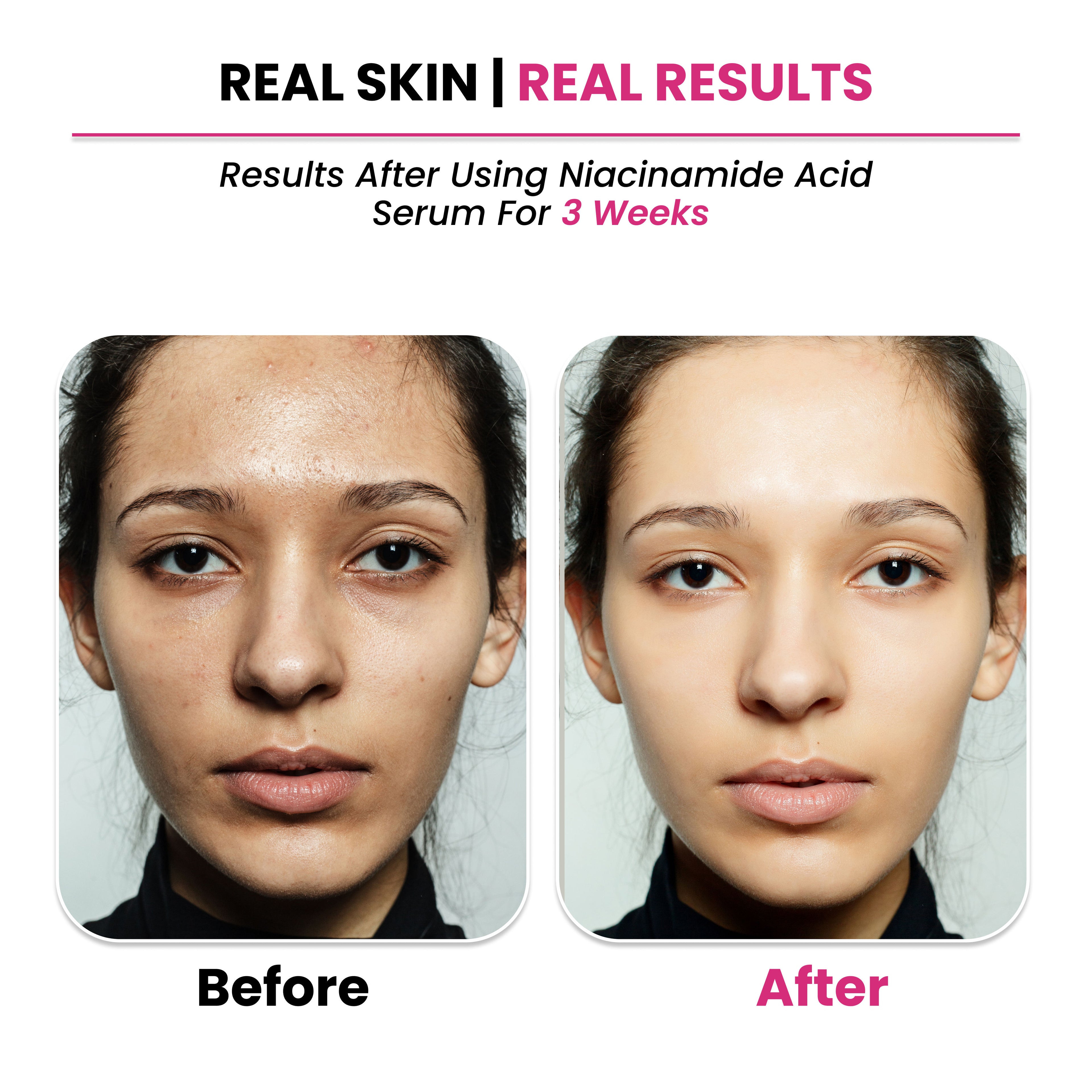 10% Niacinamide + 1% Zinc PCA Serum
