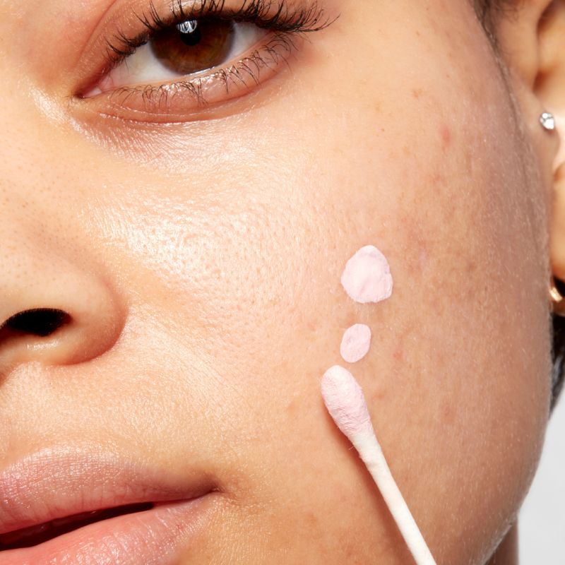 Acne Spot Corrector Drying Lotion with Salicylic Acid