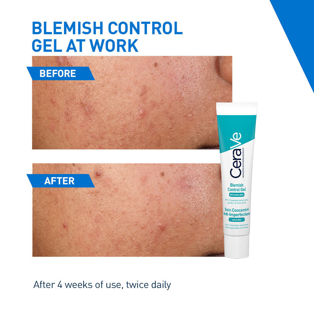 Blemish Control Gel with 2% Salicylic Acid, AHA & Niacinamide for Acne Spot Treatment
