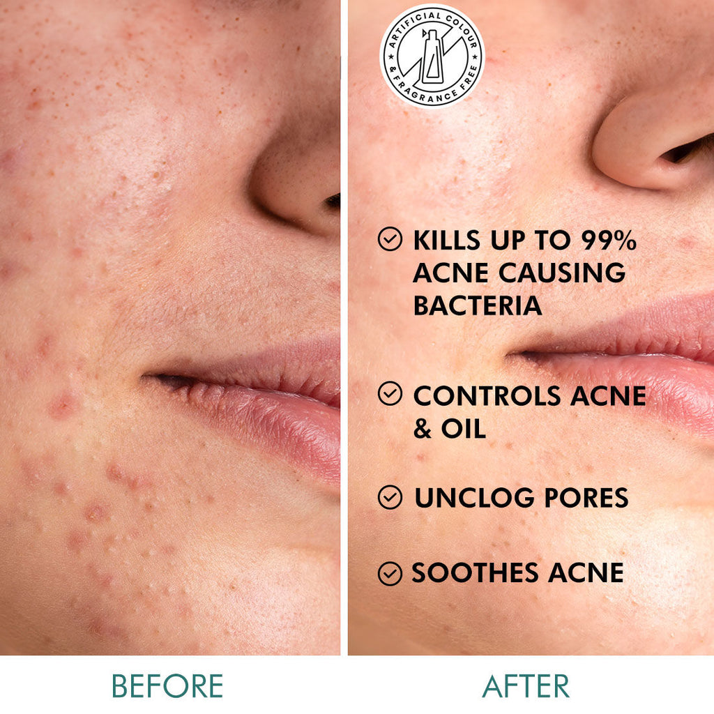 2% Salicylic Acid & Zinc Anti-Acne Pads For Clear Skin Serum Pads With Matcha Tea