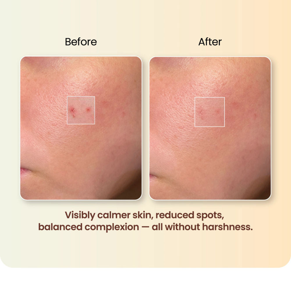 Spot Corrector Gel
