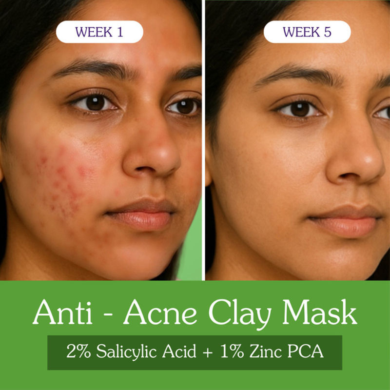 2% Salicylic Acid + 1% Zinc PCA Clay Mask for Anti-Acne, Open Pores, and Blackheads