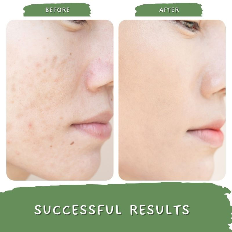 Pigmentation Removal Cream, Brightening Day And Night Cream Kojic Acid, Niacinamide