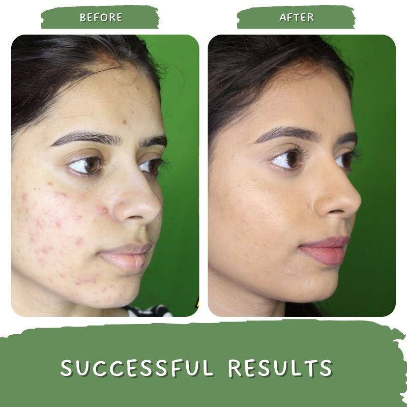 Acne Gel Cream, Face Moisturizer For Oily Skin With Green Tea, Best Cream For Pimple