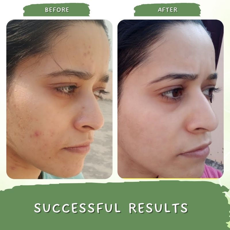 De Tan Face Pack For Pigmentation, Glowing Skin For Women With Green Coffee