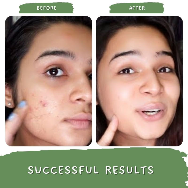 De Tan Face Pack For Oily & Acne Skin, Balances Oil & Sebum Green Tea & Glycolic Acid