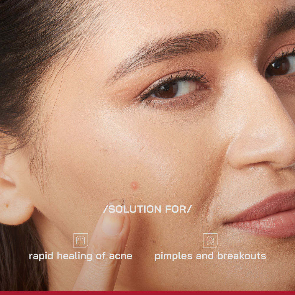 (PHD) Salicylic Acid Acne Spot Gel