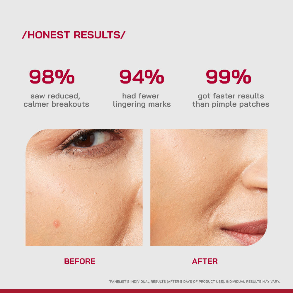 (PHD) Salicylic Acid Acne Spot Gel