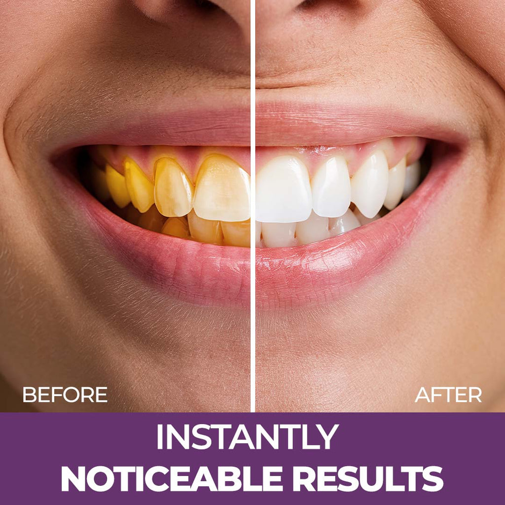 Purple Teeth Whitening Gel, Colour Corrector For Yellow Teeth, Dental Whitening Serum