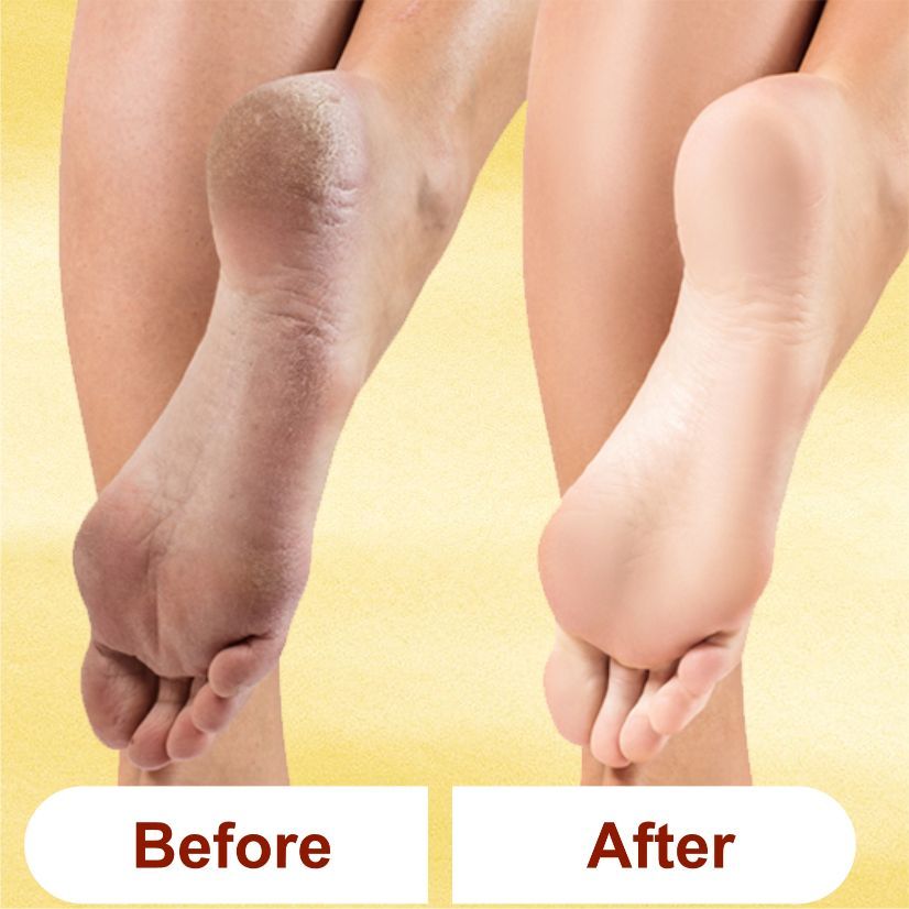 Heal & Repair Lemon Foot Cream With Shea Butter, Vitamin-e, Coconut Oil & Jojoba Oil