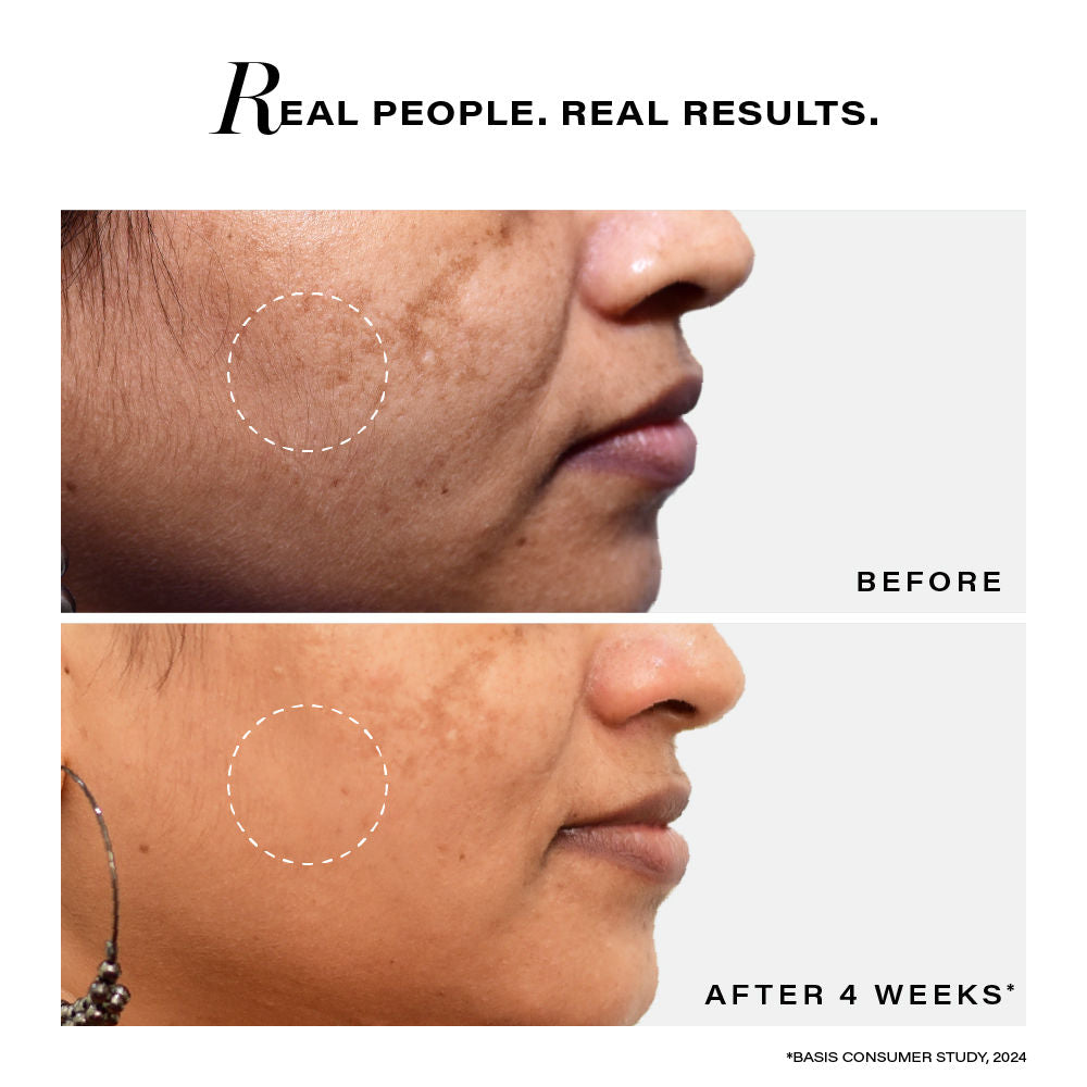 Bi-Phasic Serum For Hyperpigmentation|Dark Spots & Acne Marks|Dry - Combination Skin