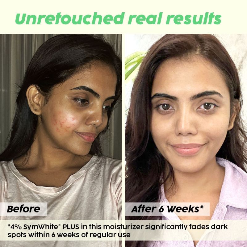 2% Alpha Arbutin Pineapple Moisturizer With SymWhite PLUS For Hyperpigmentation & Dark Spots