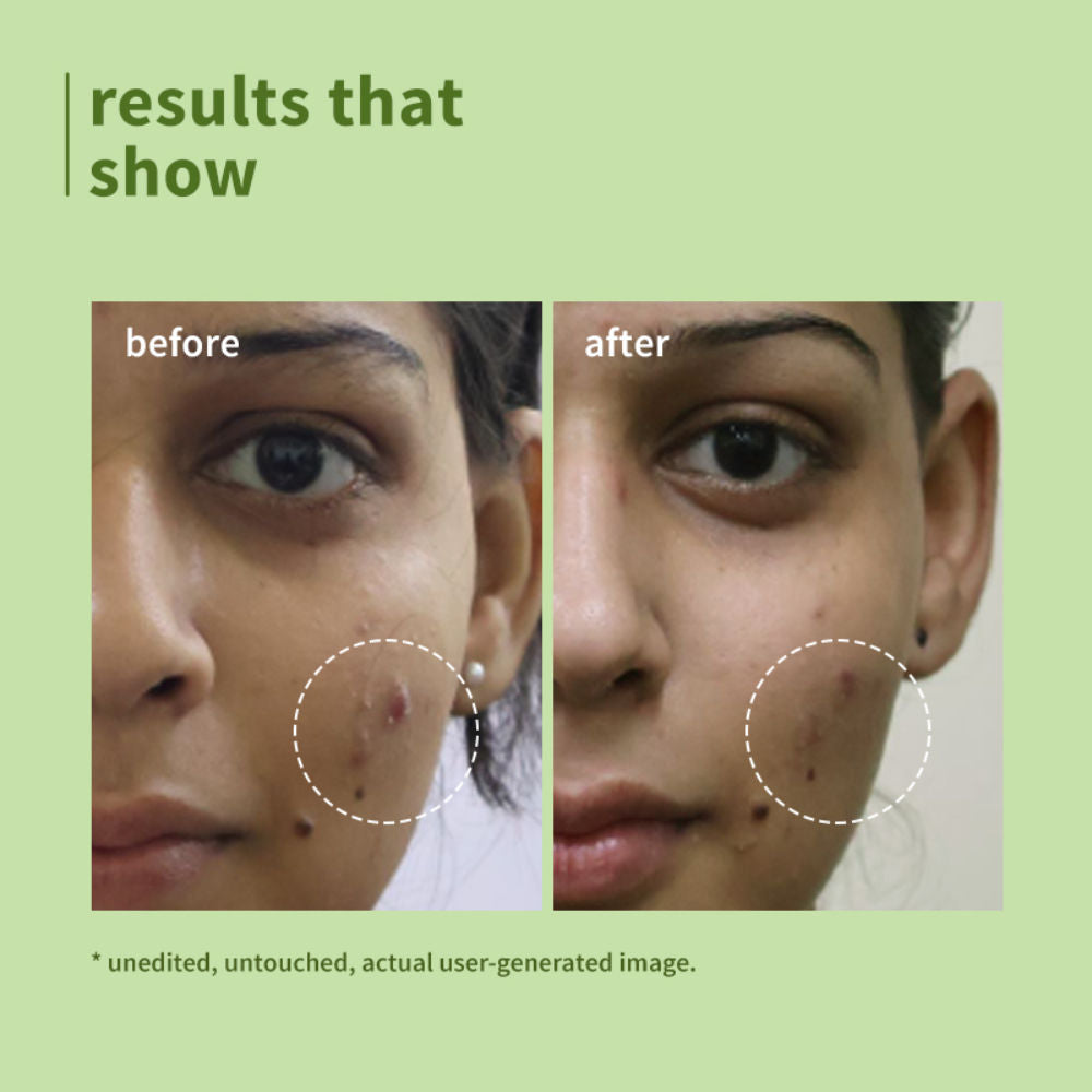 Green Tea Pore Cleansing Gel Face Wash With Glycolic Acid - Fights Acne &OilForClearSkin