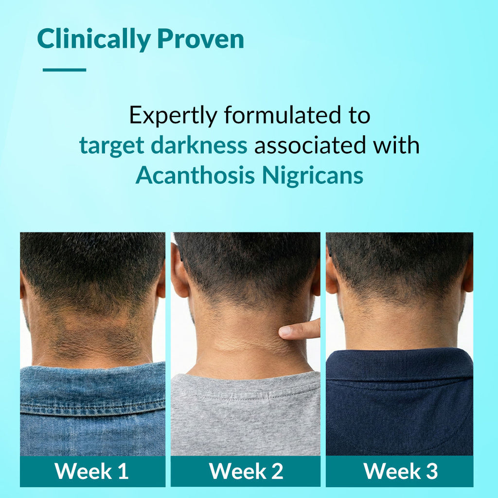 Nigrifix Advance Cream for Acanthosis Nigricans with Melatonin, Dermatologist Tested