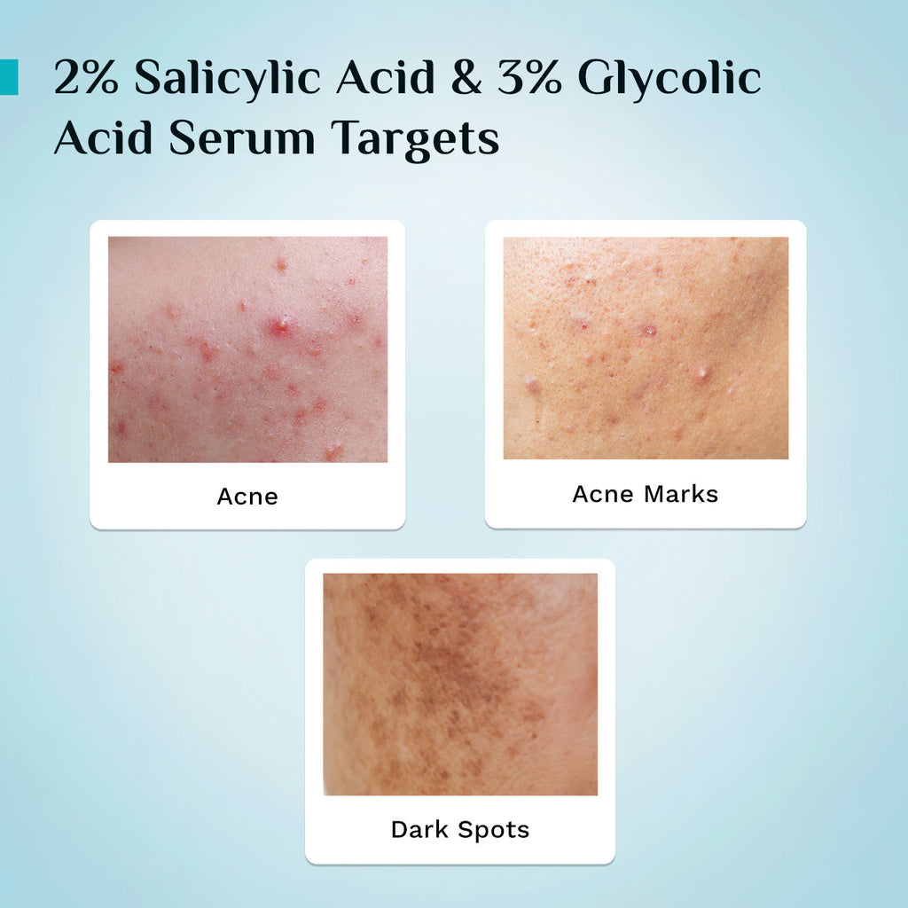Salicylic & Glycolic Acid Anti Acne Serum