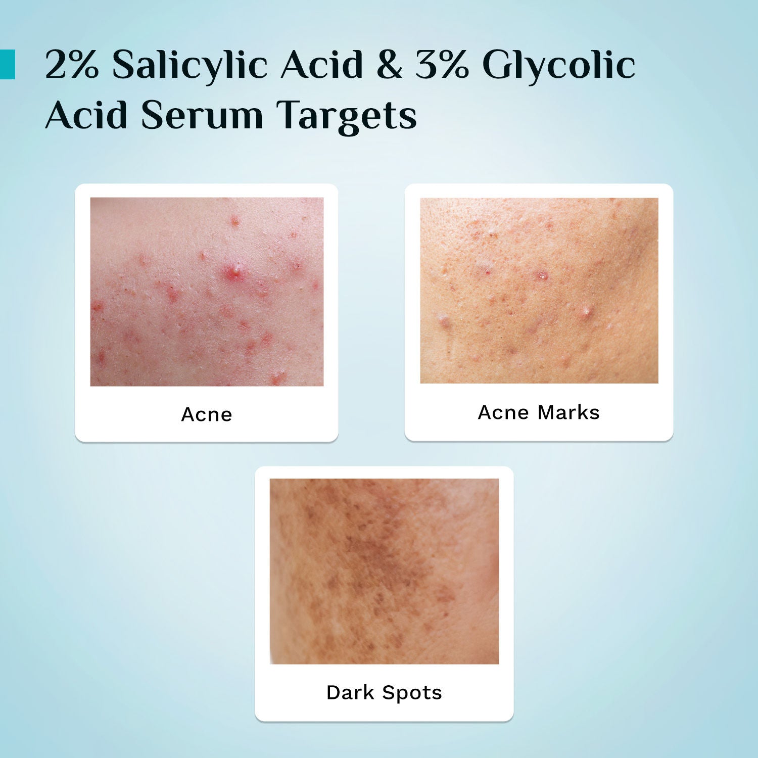Salicylic & Glycolic Acid Anti Acne Serum