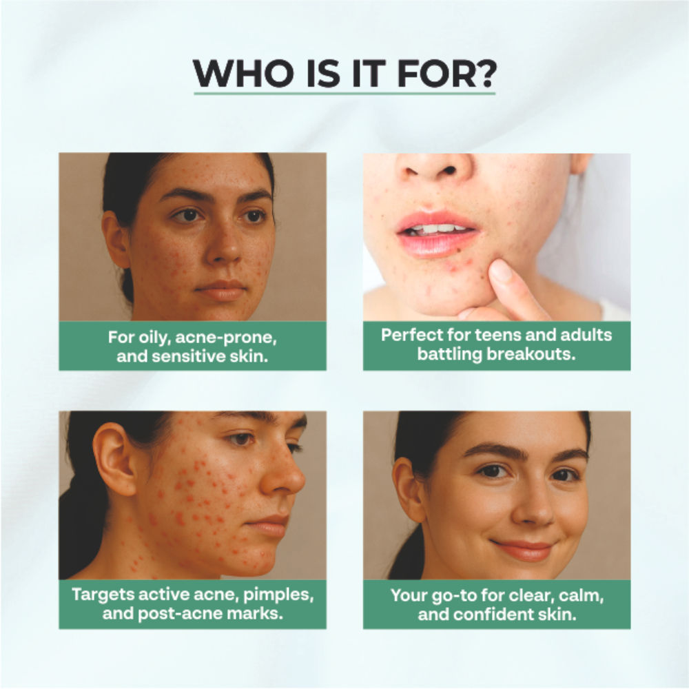Acne & Pimple Moisturizer