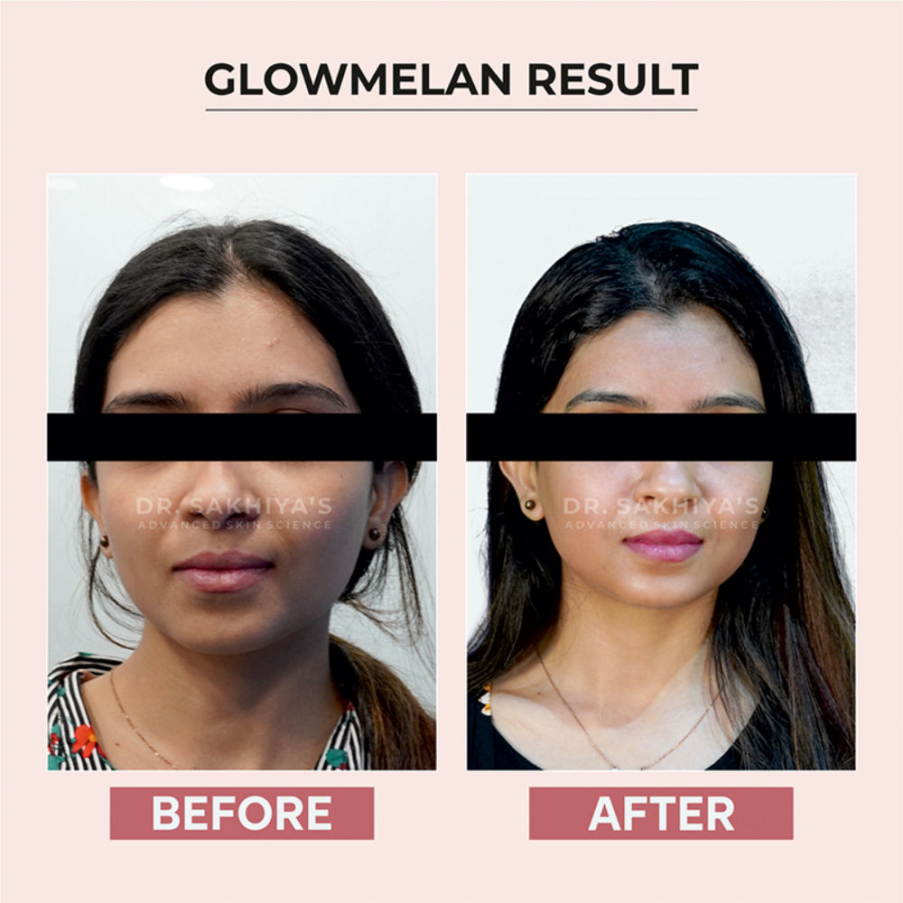 Glowmelan Brightening & Depigmentation Gel Cream