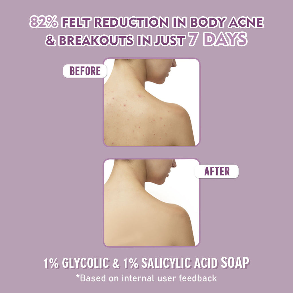 1% Glycolic Acid & 1% Salicylic Acid Body Acne Soap
