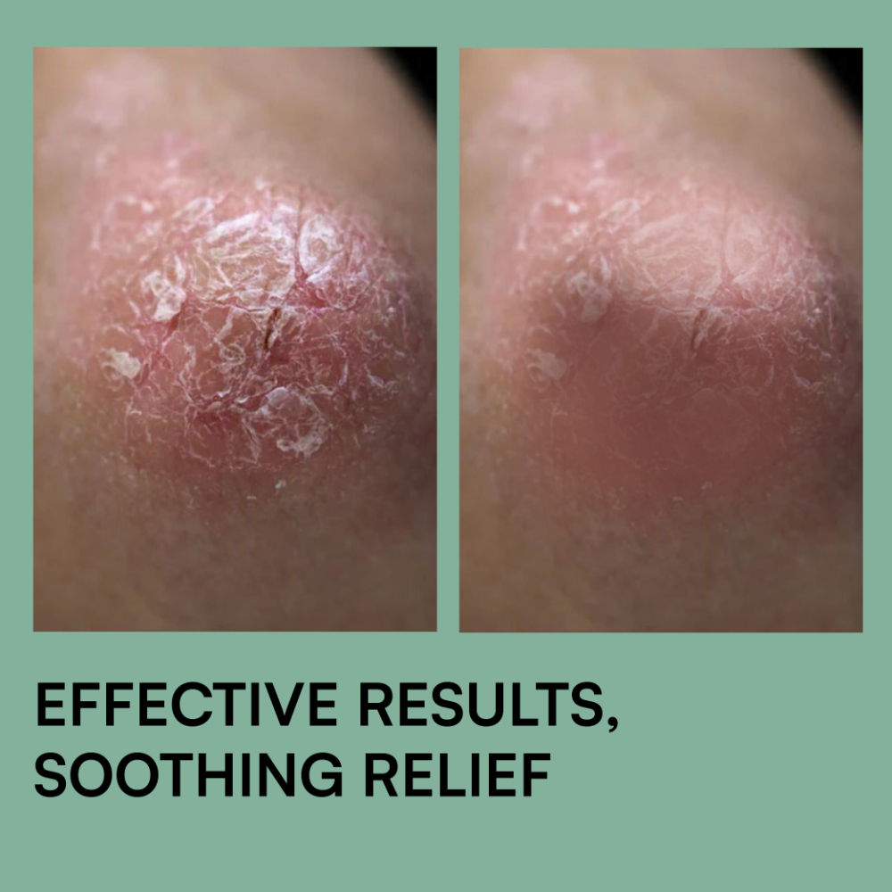 Psoramist Moisturizing Cream