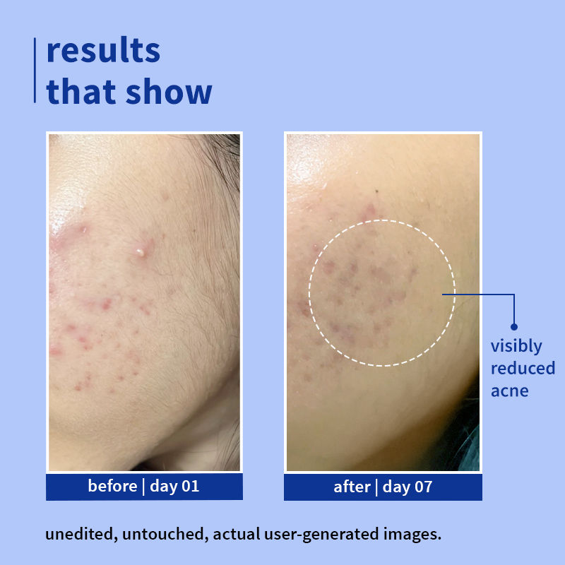 1% Salicylic Acid & Blueberry Clearly Gentle Gel Face Wash, For Acne Prone & Oily Skin