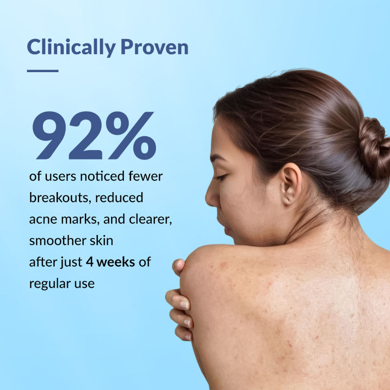 2% Salicylic Acid + 2% Azelaic Acid Salyzap AZ Acne Body Spray For Back & Upper Arms