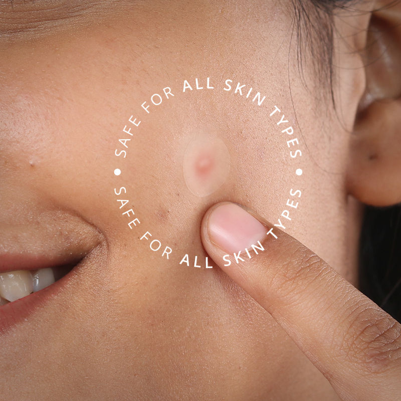 Pimple Patch for Acne, 72 Hydrocolloid and Salicylic Acid Patches, For All Skin Types