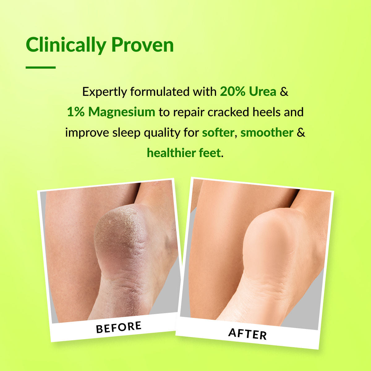 Foobetik 20% Urea Foot Roll On for Dry & Cracked Heels with 5% Lactic Acid