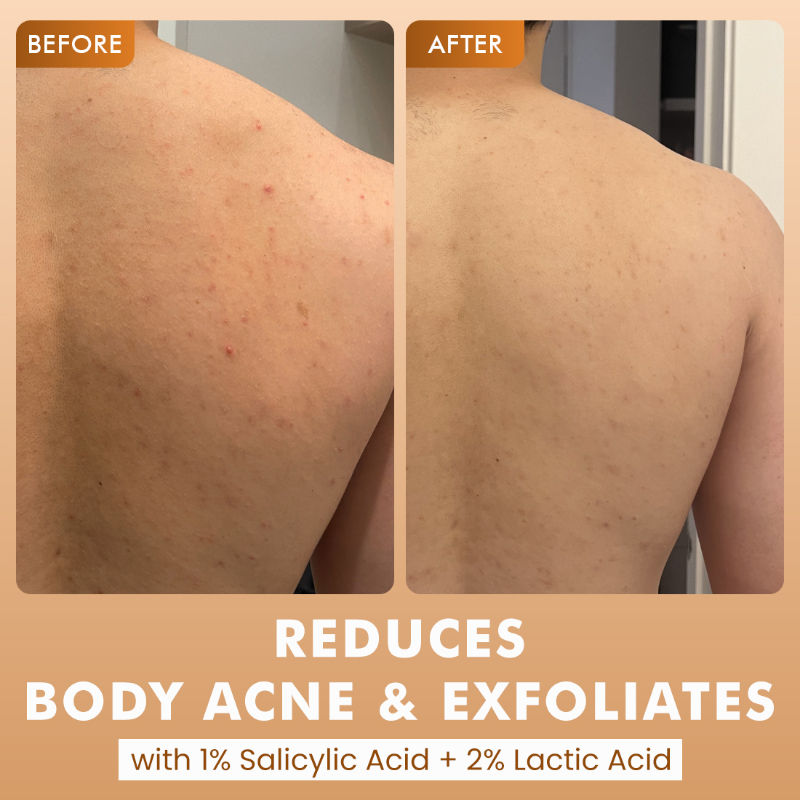 7% Exfoliating Body Wash- 1% Salicylic 2% Lactic Acid | Shower Gel to Reduce Body Acne