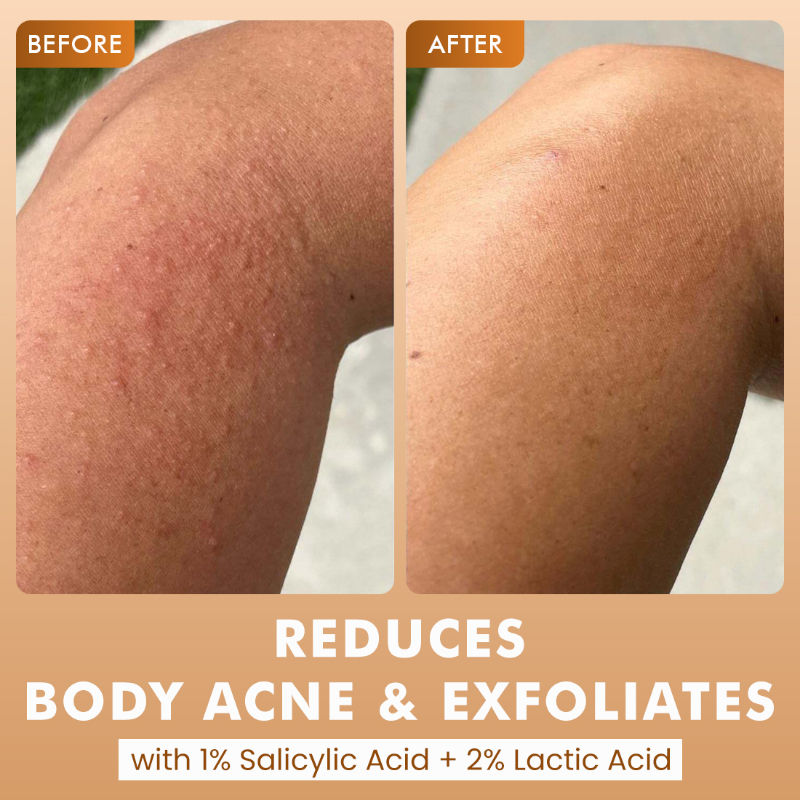 7% Exfoliating Body Wash- 1% Salicylic 2% Lactic Acid | Shower Gel to Reduce Body Acne