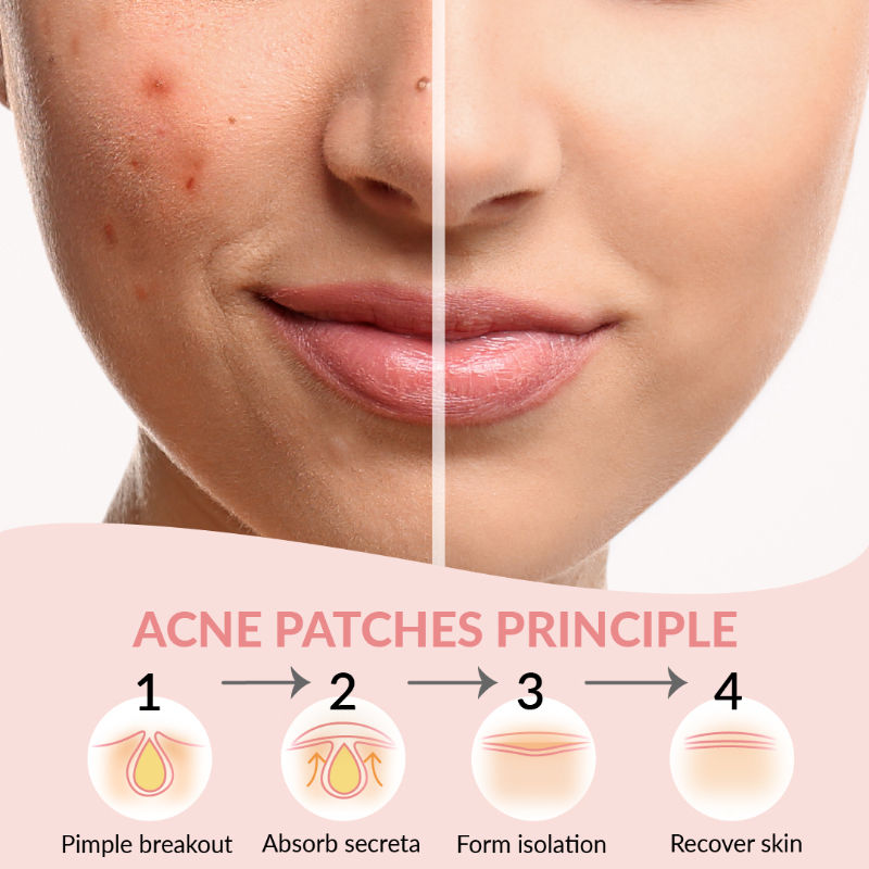 Spot Clearing Acne Pimple Patch
